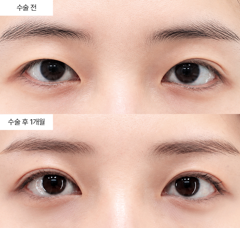 12홀 자연유착