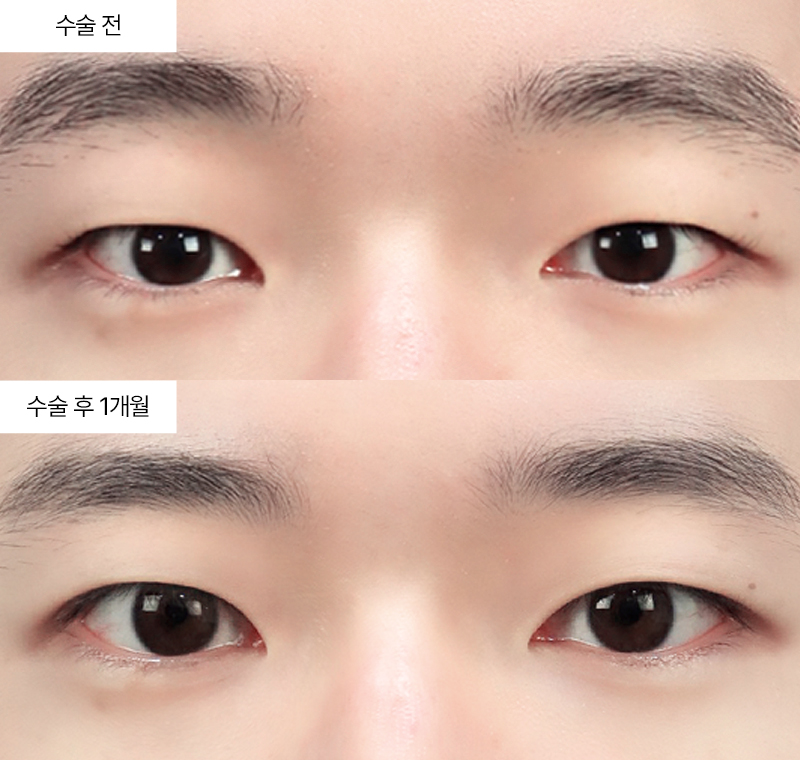 12홀 자연유착