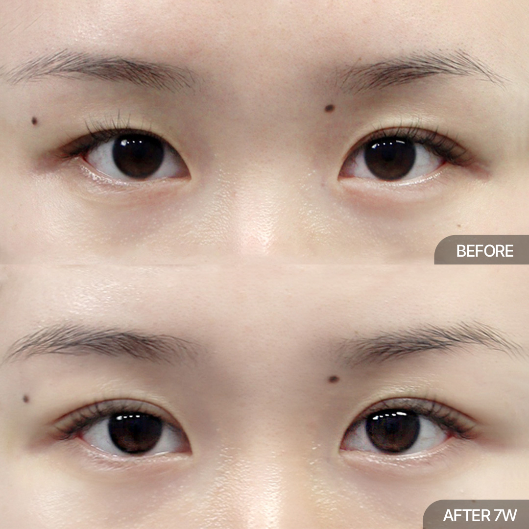 12홀 자연유착