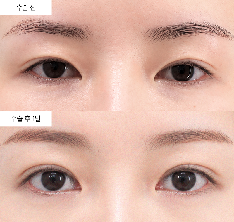이마거상+12홀 자연유착+윗트임