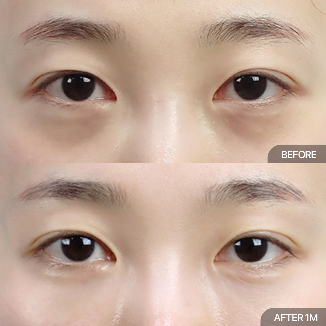 눈밑지방재배치