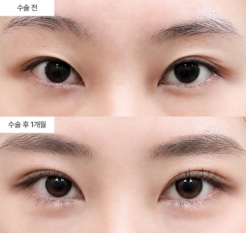 12홀 자연유착+윗트임