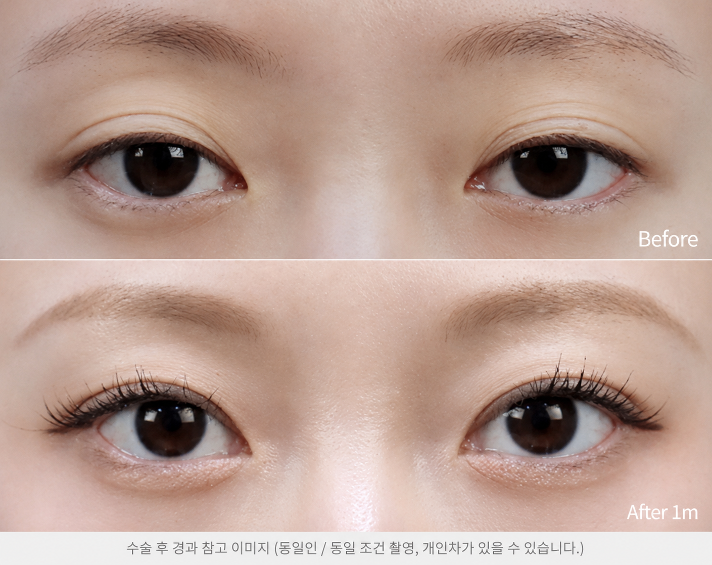 눈재수술 이유