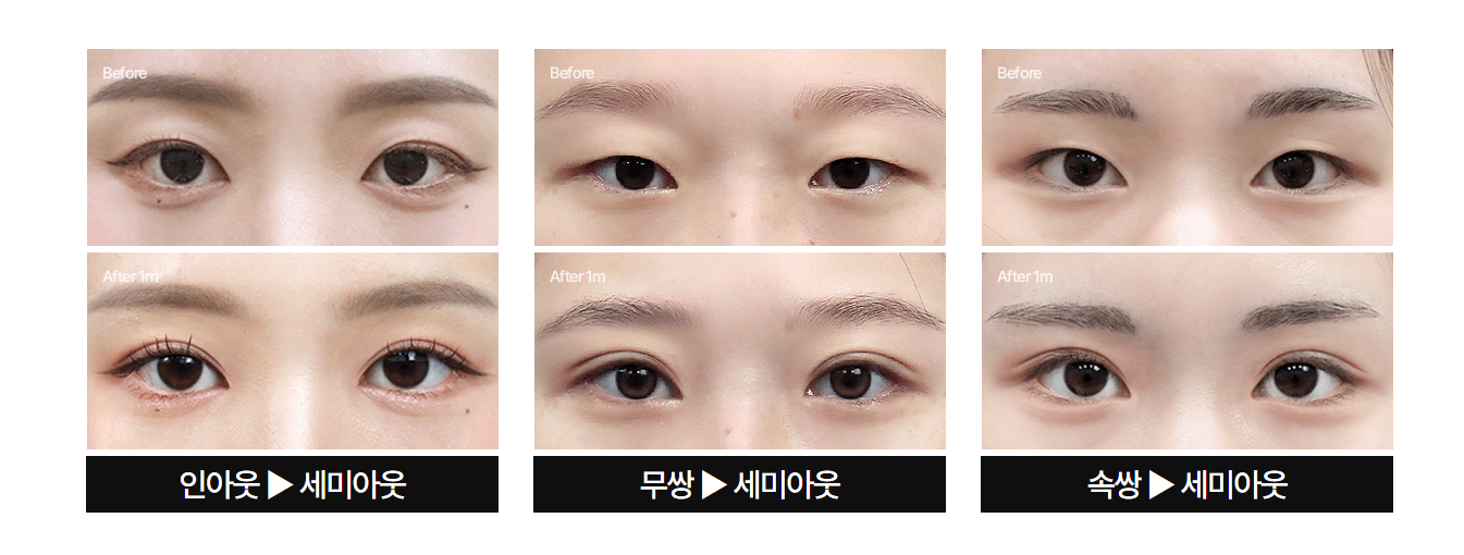 인아웃, 무쌍, 속쌍에서 세미아웃으로 — 팝성형외과