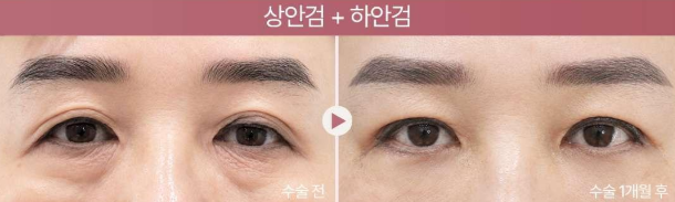 상안검 하안검 수술 전후