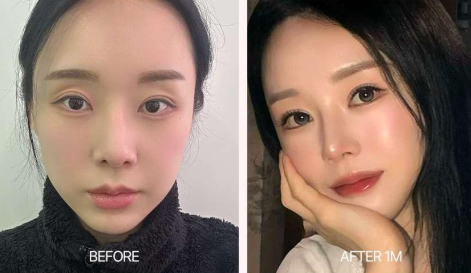 쌍꺼풀 재수술 전후