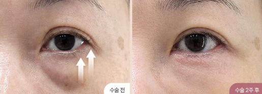 하안검 눈밑지방재배치 수술 전후