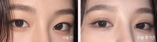쌍꺼풀 수술 전후 눈꺼풀 라인 변화 비교 — 수술 전 선이 없는 눈과 수술 후 자연스러운 쌍꺼풀 라인이 생긴 눈
