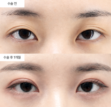 Ptosis Correction Revision: When is the Best Time for Re-surgery?