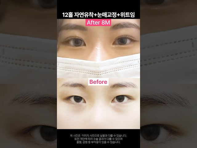 [눈 성형 전담센터] 팝성형외과의 12홀 자연유착