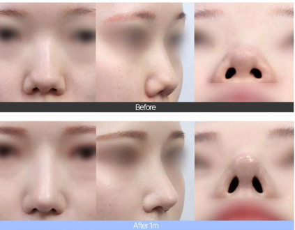 [눈코 성형 센터] 복코 교정 꼭 해야 할까?