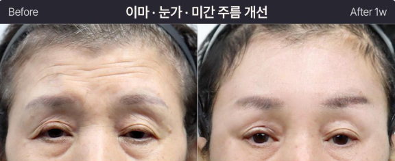 [리프팅 전담 센터] 이마거상, 흉터 걱정되시나요?