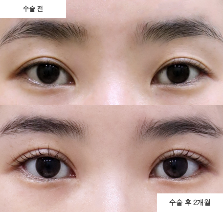 [눈 성형 전담센터] 뒤트임 수술, 눈 길이와 크기에 어떤 변화를 줄까요
