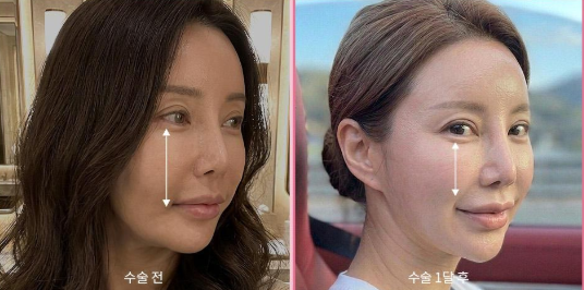 [리프팅 전담 센터] 미니안면거상, 전통 안면거상과 어떻게 다를까요