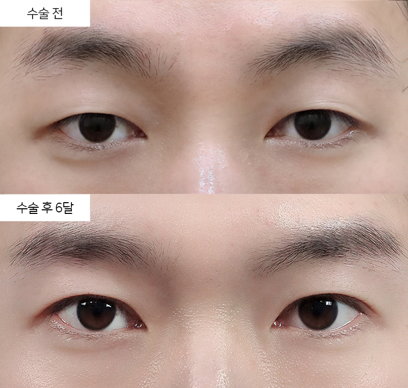 눈꺼풀 피부 절제, 처진 눈꺼풀과 어떻게 다를까요