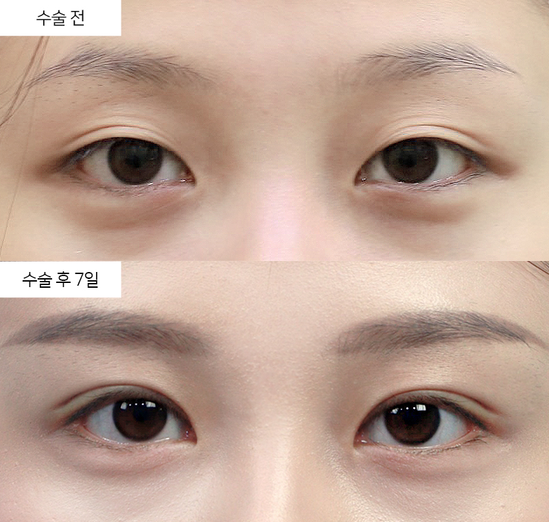 눈꺼풀 하수 교정, 졸려 보이는 눈을 개선하는 방법