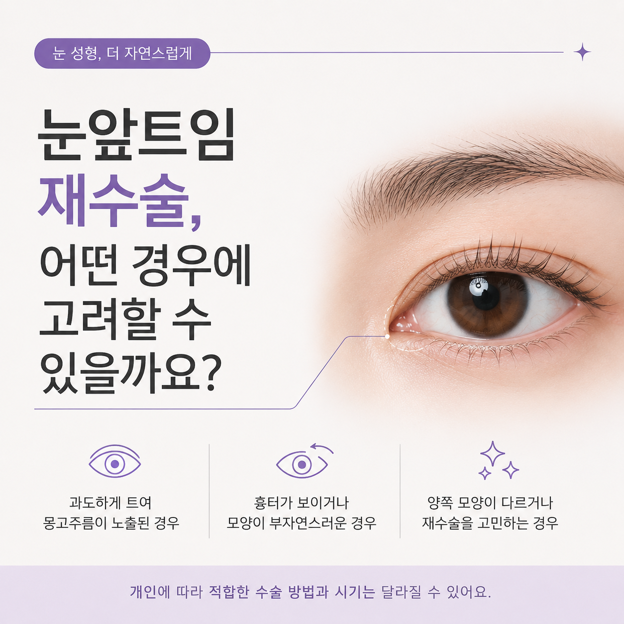 눈앞트임 재수술, 어떤 경우에 고려할 수 있을까요