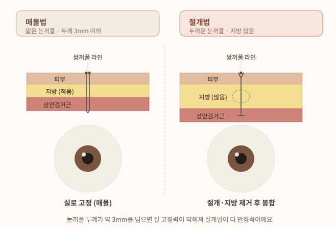 쌍꺼풀 수술 ㅣ 쌍수