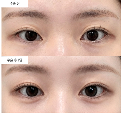 쌍꺼풀 수술, 예쁘게 되는 것보다 중요한 게 있어요