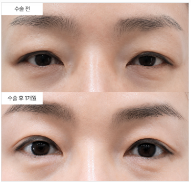 상안검 수술 붓기, 실제로 얼마나 걸리나요?