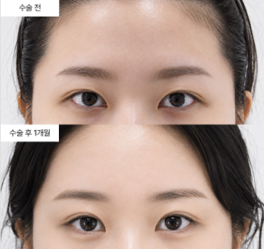 이마거상하면 눈꺼풀도 같이 올라가는 게 맞나요?