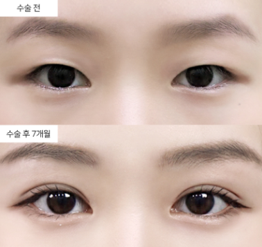 비절개 쌍꺼풀, 유지기간이 얼마나 되는지 수술 전에 알고 싶어요