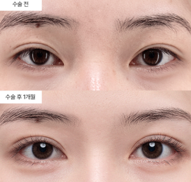 쌍꺼풀 매몰법이랑 절개법, 가격 차이만큼 다른 게 있을까요?