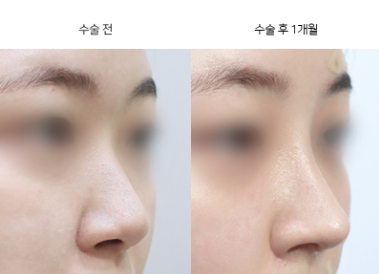 눈성형 절개법이랑 비절개법 차이가 뭔가요?