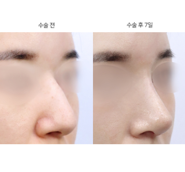 매부리코 재수술, 언제 고려해야 할까요?