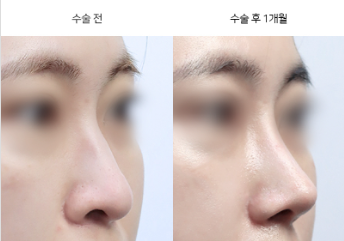 코성형, 내 코 모양에 맞는 수술인지 먼저 확인해야 해요