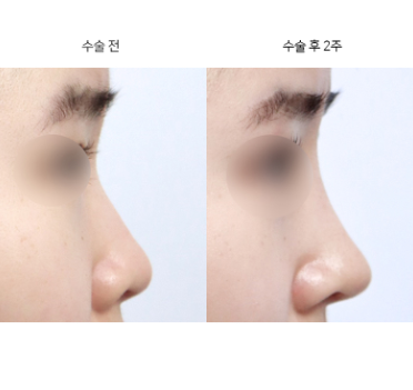 코끝성형이 코 모양을 망친다는 게 사실인가요?