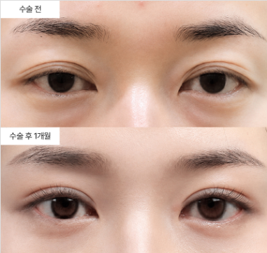 눈매교정 비용, 얼마나 드는 게 보통이에요?