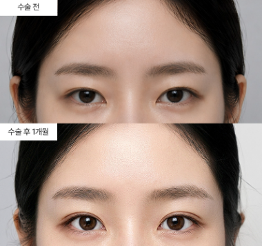내시경이마거상 결과가 마음에 안 들면 재수술이 가능한가요?