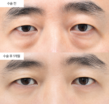 하안검 재수술, 언제 고려해야 할까요?
