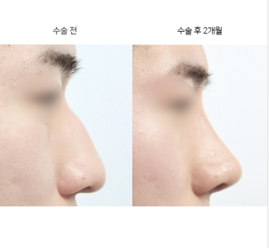 코수술 콧대 높이, 어떤 기준으로 정해야 할까요?
