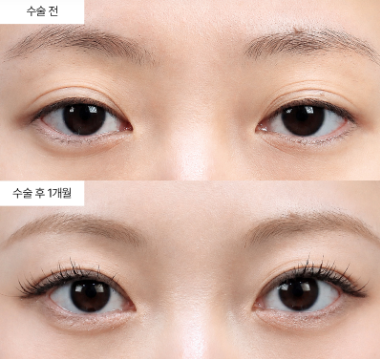 눈밑지방재배치 후 왜 다시 꺼지는 경우가 생기나요?
