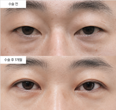 안검하수 수술이랑 눈매교정 수술이 같은 거 아닌가요?