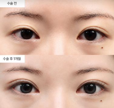 눈매교정이 풀렸을 때 재수술 비용은 얼마나 드나요?