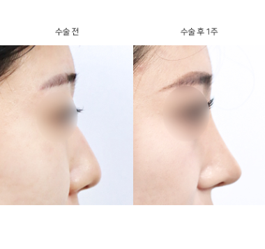 코재수술잘하는곳 찾기 대장정, 시작 전에 '시기'부터 확인해요