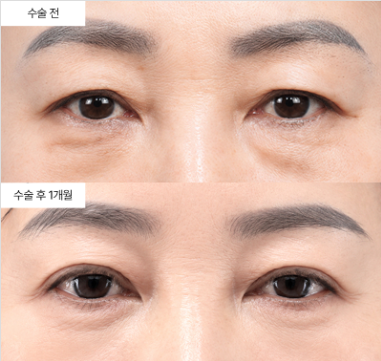 안검하수, 쌍꺼풀 수술로도 고쳐진다는 게 사실인가요?