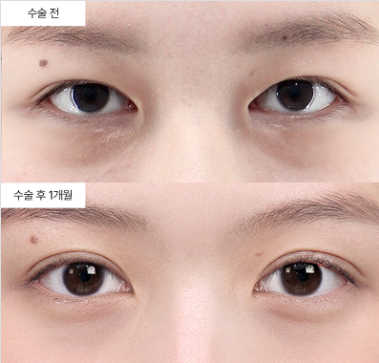 눈매교정 재수술, 언제 고려해야 할까요?