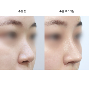 코끝성형, 자연스러운 라인을 만들려면 어떤 방법을 선택해야 할까요?