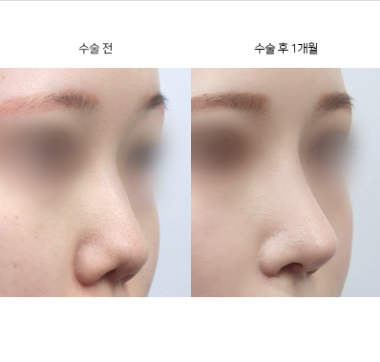 콧대성형이 원래 코뼈랑 관계없다는 게 사실인가요?