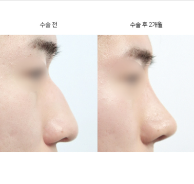 매부리코 재수술, 언제쯤 고려해야 할까요?
