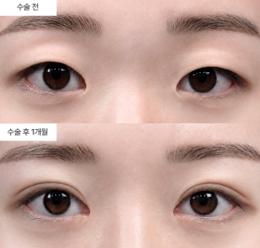 쌍꺼풀 수술 비용, 왜 이렇게 차이가 날까요?