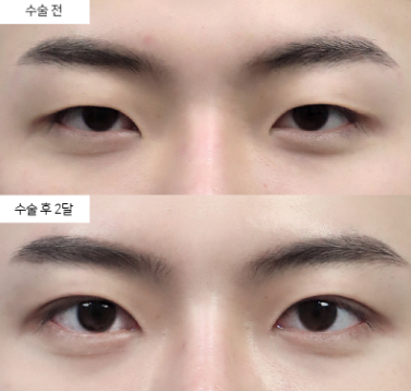 안검하수 수술, 몇 살 때 받는 게 맞을까요?