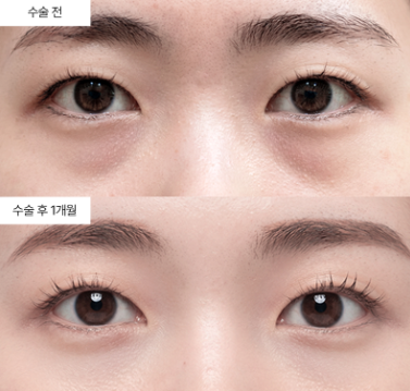 눈밑지방재배치, 20대에 해도 괜찮을까요?