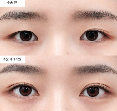 눈성형 한 번 하면 영구적으로 유지되나요?