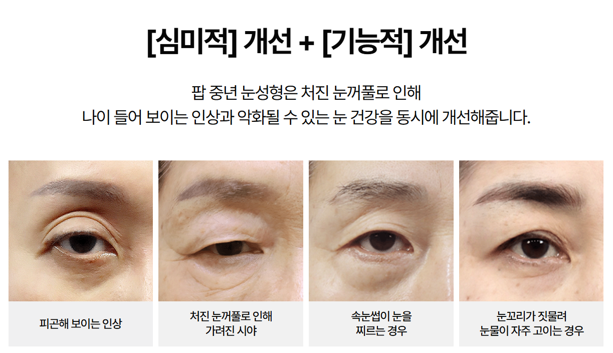 상안검 수술, 적합한 나이가 따로 있나요?