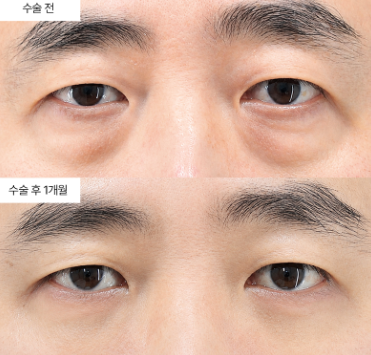 하안검 수술 후 흉터, 정말 눈에 띄게 남을까요?